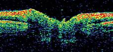 tomografia optica coherente en nervio optico